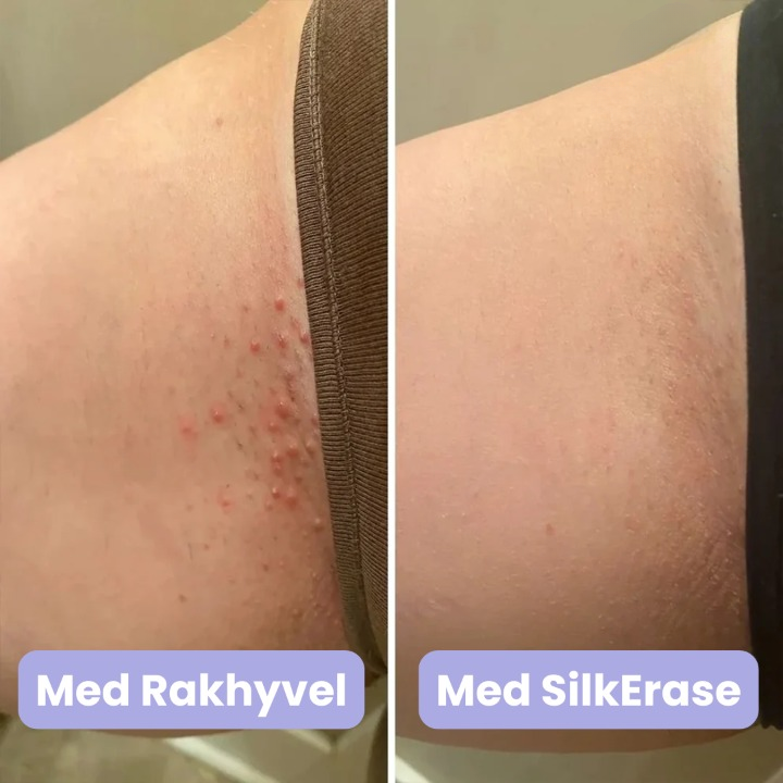 SilkErase - Silkeslen och smärtfri rakning